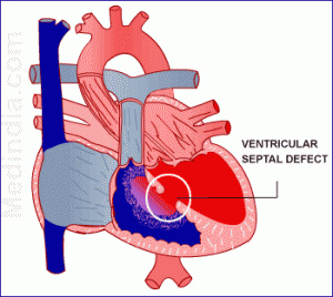 Ventrikel-septum-defect